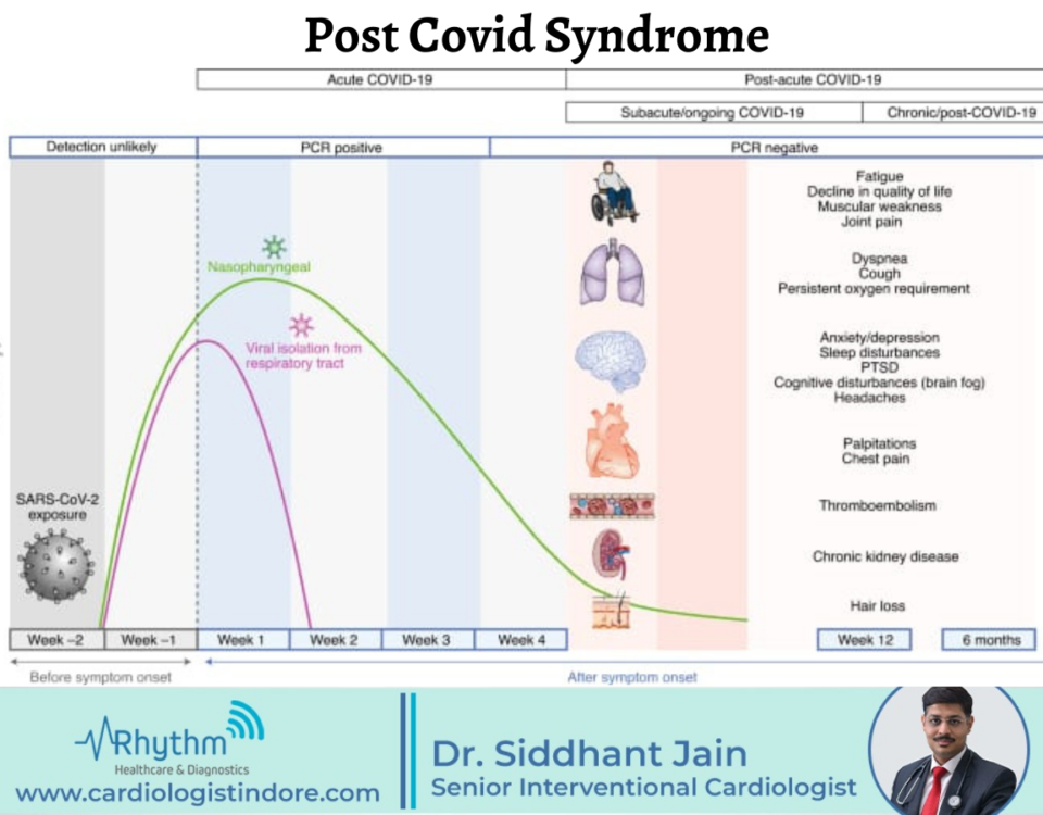 Post Covid Syndrome - cardiologist indore