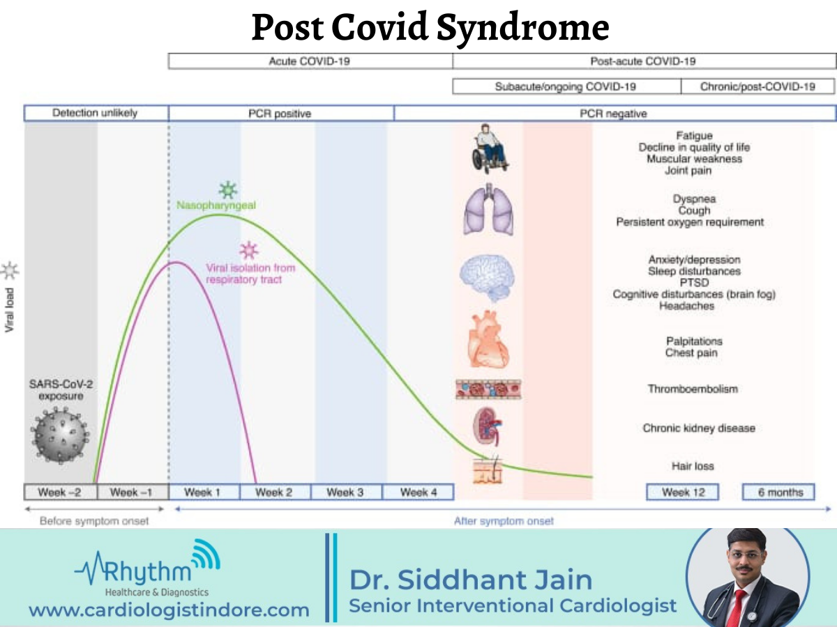 Post Covid Syndrome - cardiologist indore