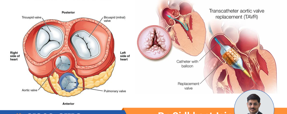 What is the TAVI Process - cardiologist indore