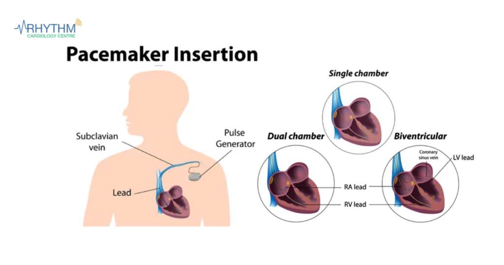 Types of pacemaker - cardiologist indore