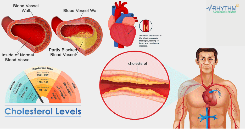 Best Heart Specialist in Indore - Know About Cholesterol